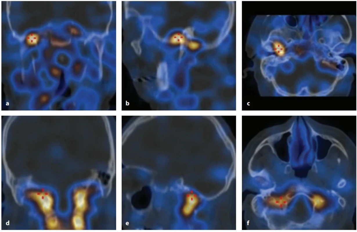 Scintigrafi e 99mTc-HMPAO značenými leukocyty. Diagnostika nekrotizujícího zánětu zevního zvukovodu. SPECT/CT: a, d) Koronární rovina. b, e) Sagitální rovina. c, f) Axiální rovina. Na SPECT/CT zobrazení 4 hod a 24 hod po aplikaci radiofarmaka je patrná zvýšená akumulace značených autologních leukocytů v oblastech: temporomandibulární kloub, fossa mandibularis, sutura petrotympanica (a–c) a spodní plocha skalní kosti (d–f) na pravé straně. Fig. 1. 99mTc-HMPAO-labelled leukocyte scintigraphy. Pre-treatment diagnosis of necrotizing external otitis. SPECT/CT: a, d) Coronar plane. b, e) Sagittal plane. c, f) Axial plane. On delayed (4 h post-injection) and late (24 h post-injection) fused SPECT/CT images a higher accumulation of labelled leukocyte is visible in the areas: temporomandibular joint, mandibular fossa, petrotympanic suture (a–c) and inferior surface of petrous part of the temporal bone (d–f ) on the right side.