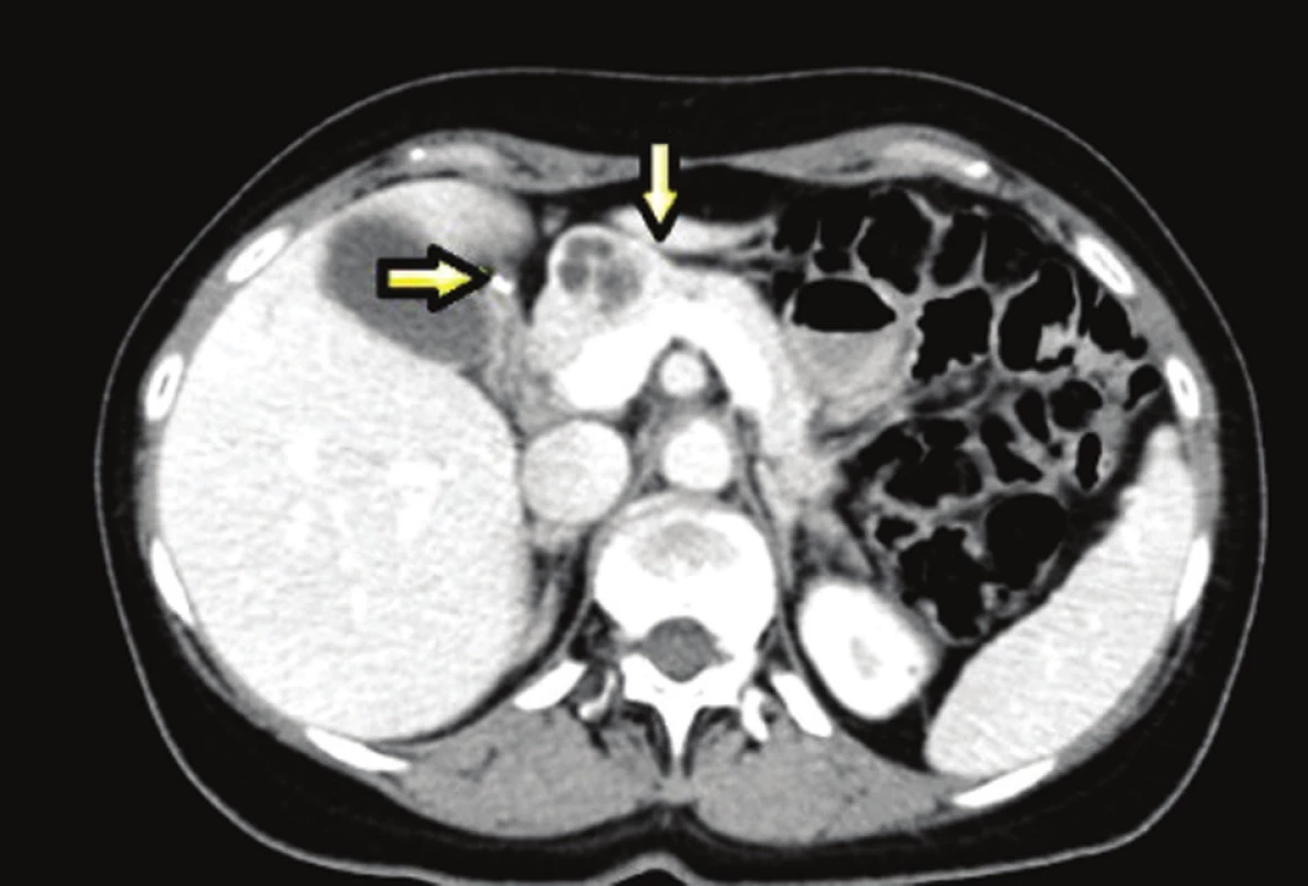 Léze v oblasti pankreatu a duodena
Fig. 3: Pancreatic and duodenal lesions