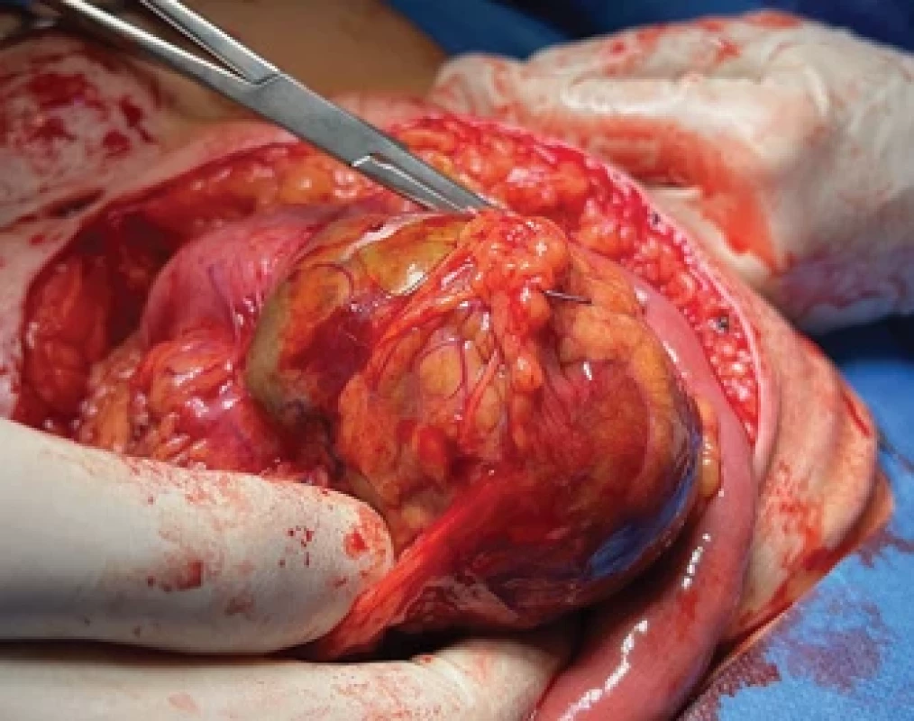 Peroperační nález. Fig. 5. Intraoperative fi nding.