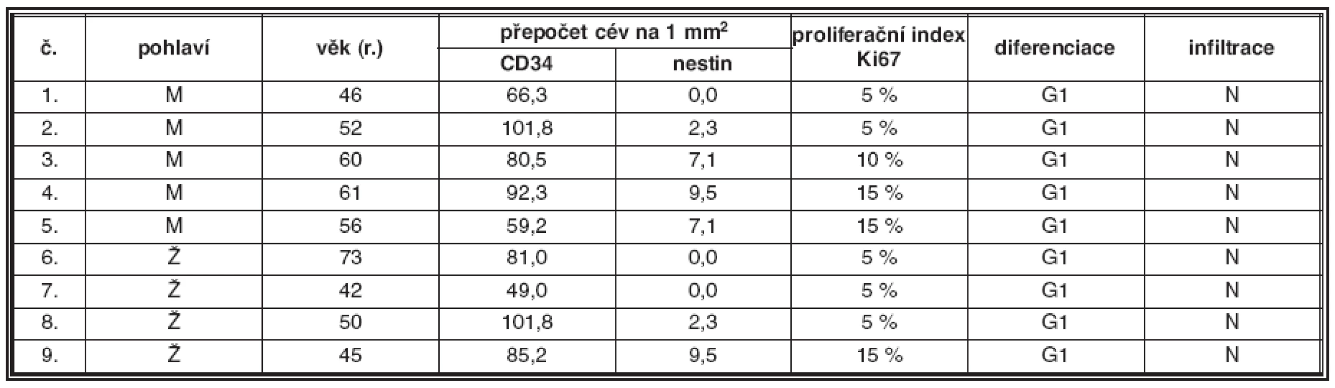Plazmocytární myelom G1, nodulární infiltrace