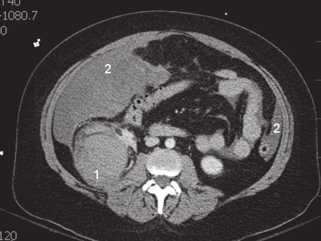CT vyšetření pacientky před operační revizí. Na snímku je patrný tumor pravé ledviny (1) a hemoperitoneum (2).
Fig. 1. CT scan of the patient before surgical revision. There is evident right kidney tumor (1) and haemoperitoneum (2) on the pictur.