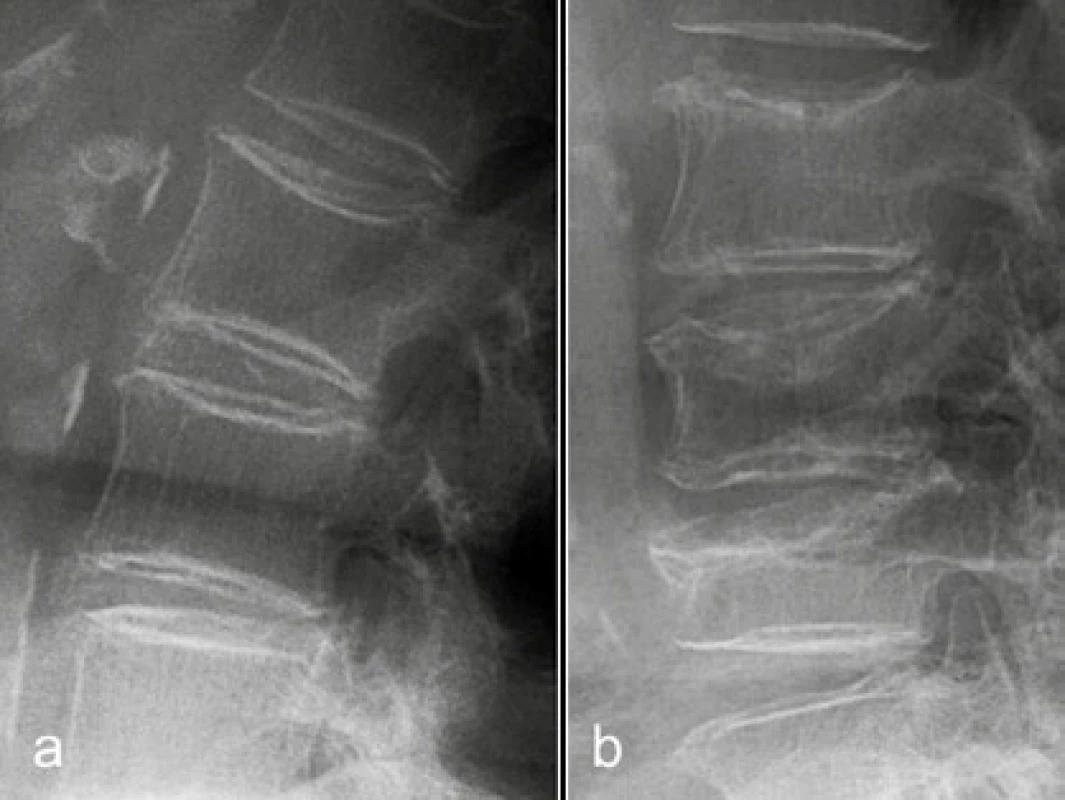 Osteopenie