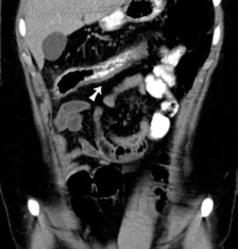CT koronárny rez: šípka označuje zhrubnutie steny colon transverzum s „dirty fat“ v okolí.
Fig. 3. CT of coronary cross-section: arrow indicates swelling of the colon traversum wall with ‘dirty fat’ in the vicinity.