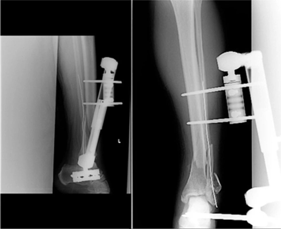 Reposice a retence na zevním fixátoru
Fig. 6: Reposition and retention with external fixator