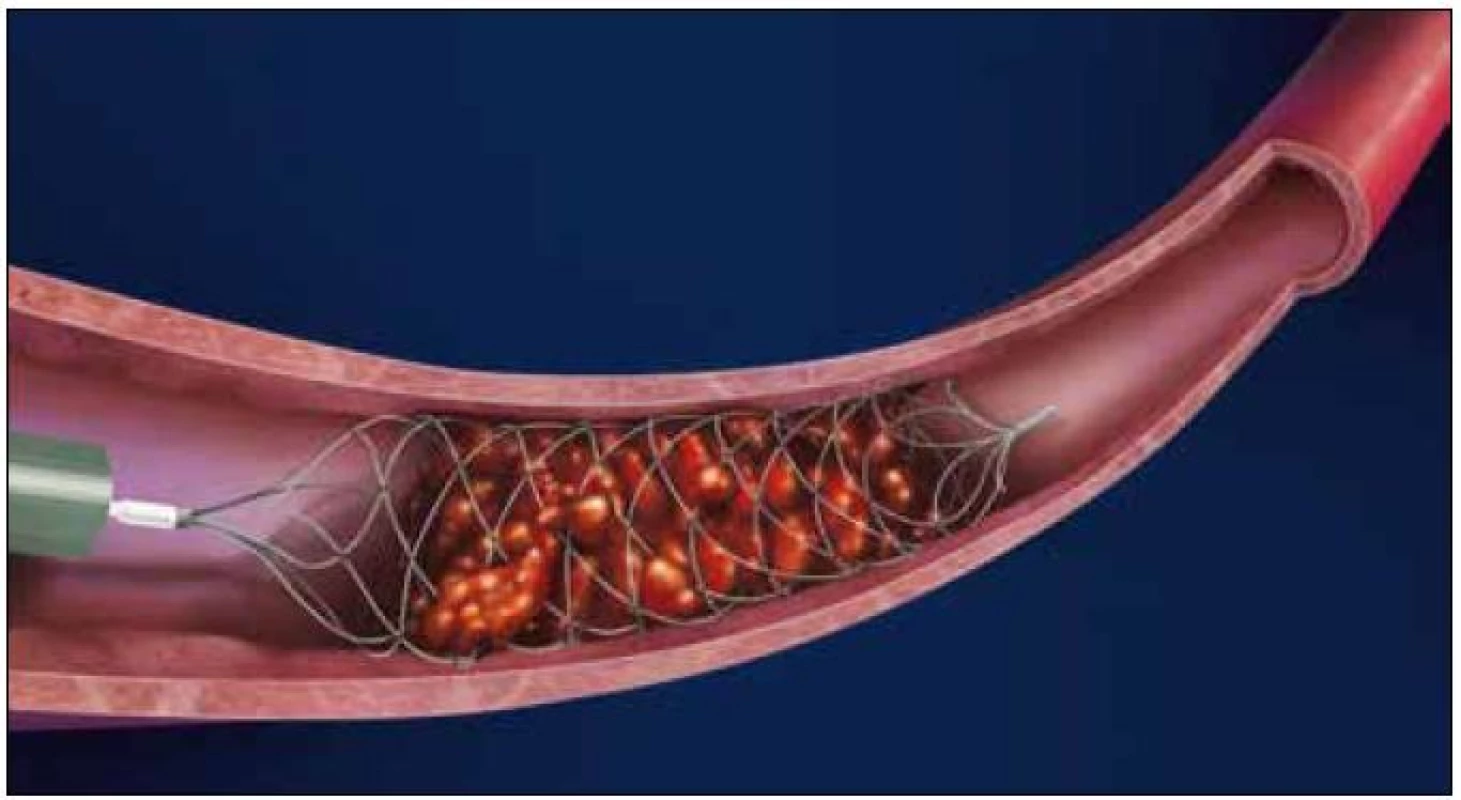 BONN ET Intracranial Flow Restoration Device<sup>®</sup> (Phenox GmbH, Bochum, SRN).
Available from: URL: http//www.phenox.info.