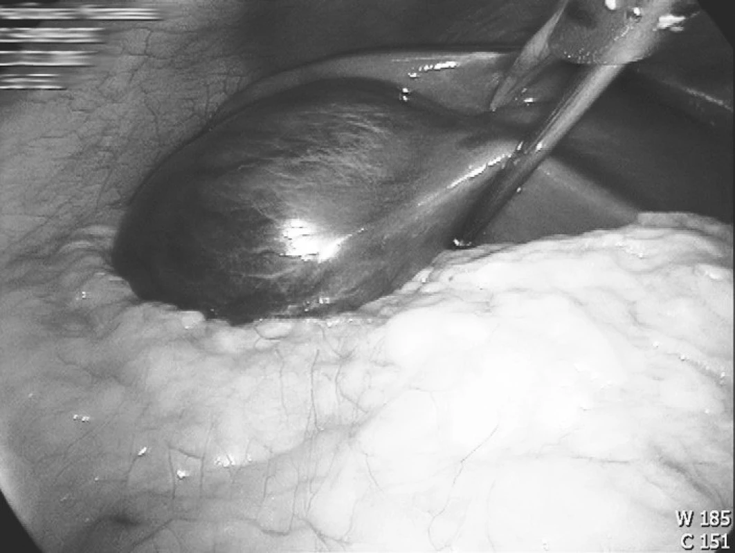 Fokální nodulární hyperplazie levého laloku jaterního
Fig. 1. Focal nodular hyperplasia of the left liver lobe