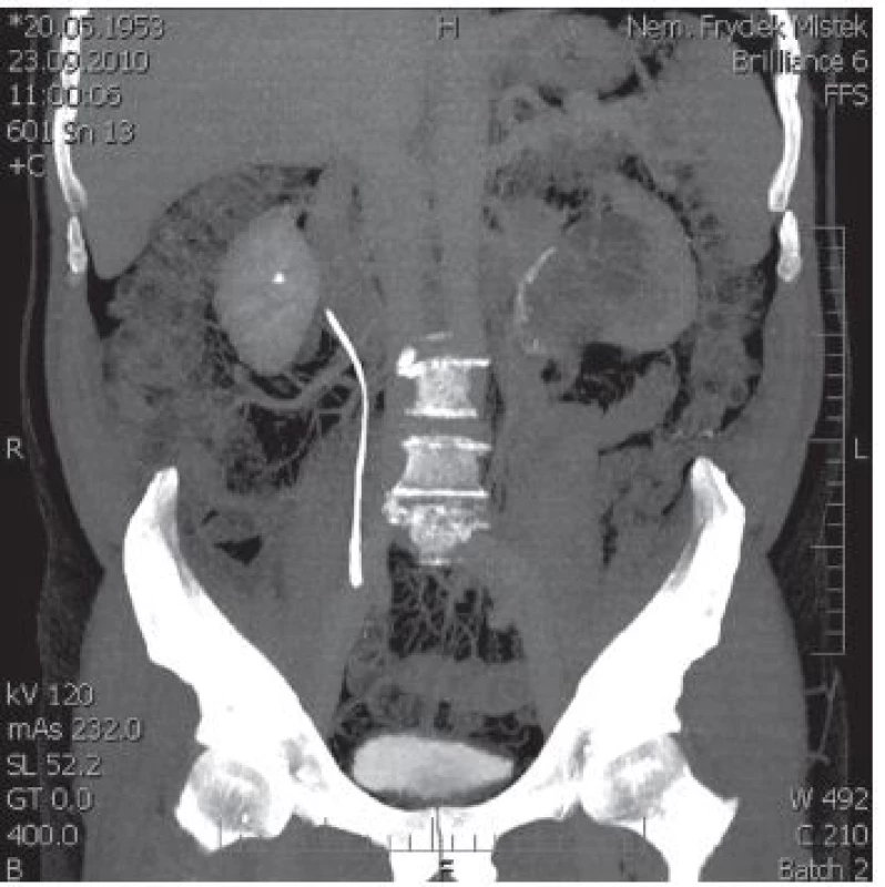 CT + IVU s afunkcí levé ledviny a osifikací stěny pánvičky
Fig. 1. Afunctio of the left kidney with calcification of pelvis wall on CT + IVU