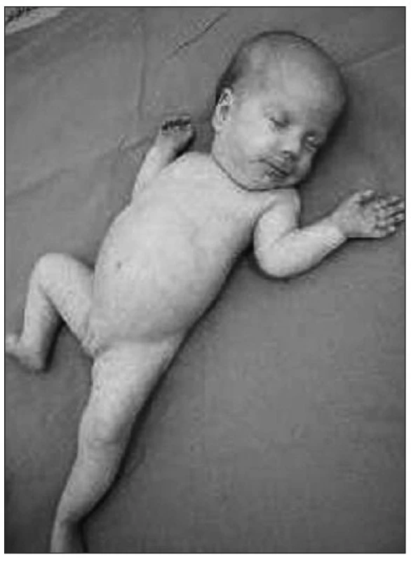 Kazuistika 1. Drobná faciálna dysmorfia, apatia, hypomímia.
Fig. 2. Case report 1. A minor facial dysmorphia, apathy, hypomimia.