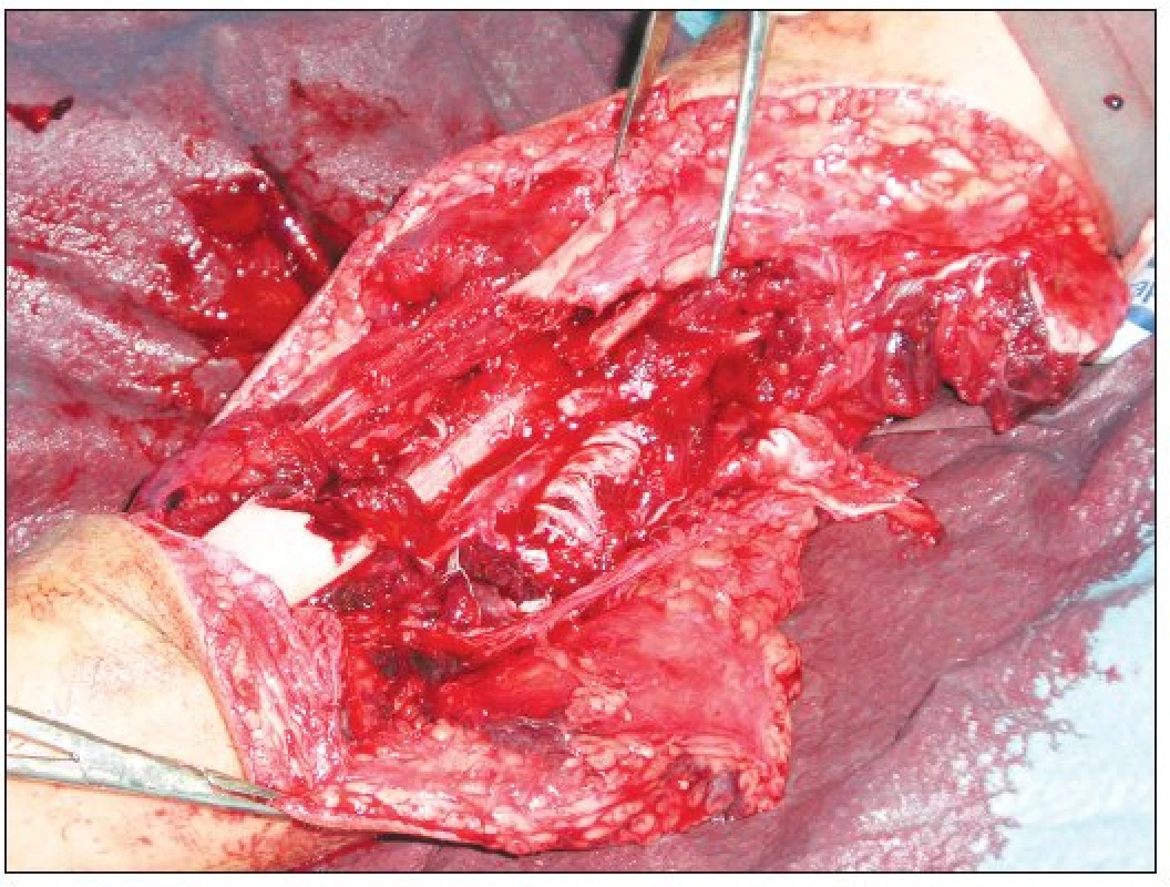The extent of bone comminution and soft tissue injury – detail view