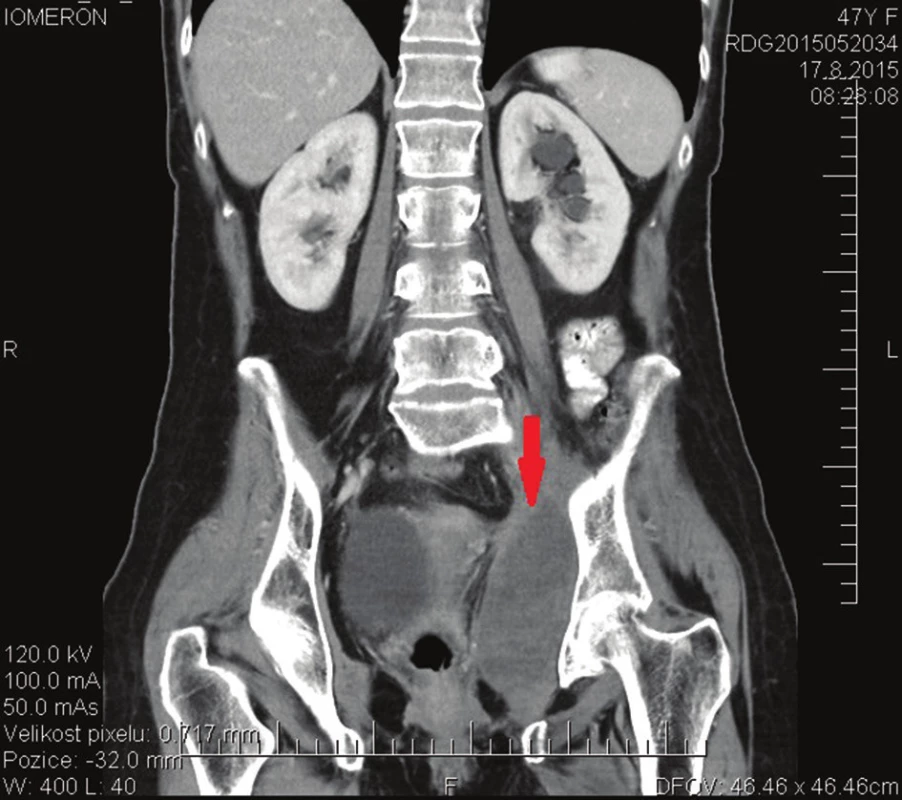 CT vyšetření po R2 resekci ve druhé době
Fig. 3: CT scan after the second line R2 resection