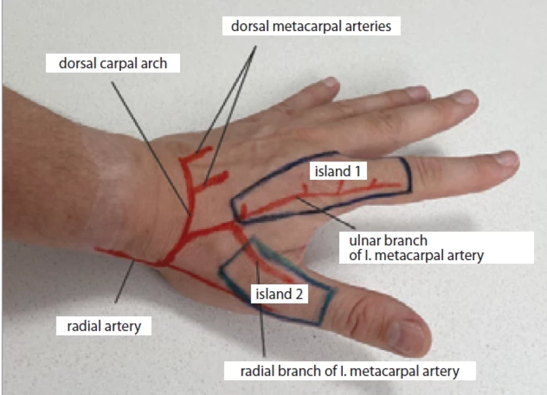 Free fl ap of the fi rst dorsal metacarpal artery. (Source: author’s photo archive).