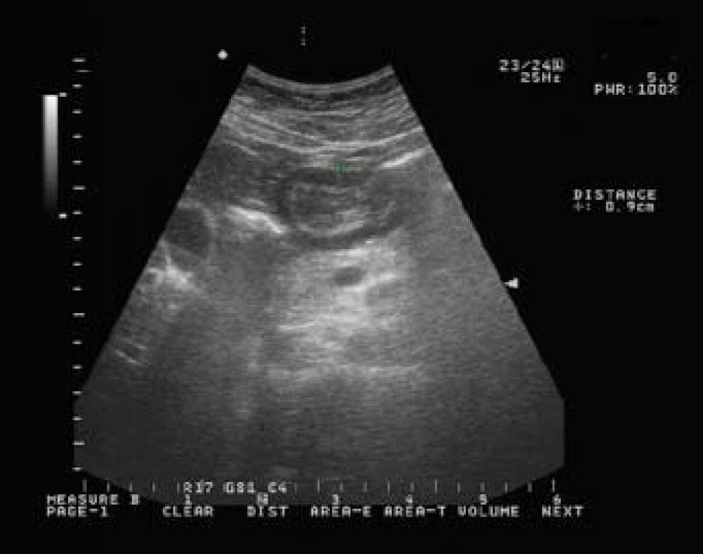 Sonografický obraz rozšíření stěny žaludku.
Fig. 4. Thickening of the stomach wall in abdominal ultrasonography.