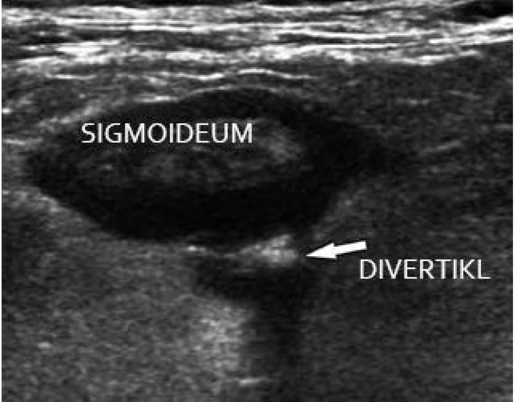 Divertikulitida sigmoidea.
Fig. 12. Sigmoid diverticulitis.