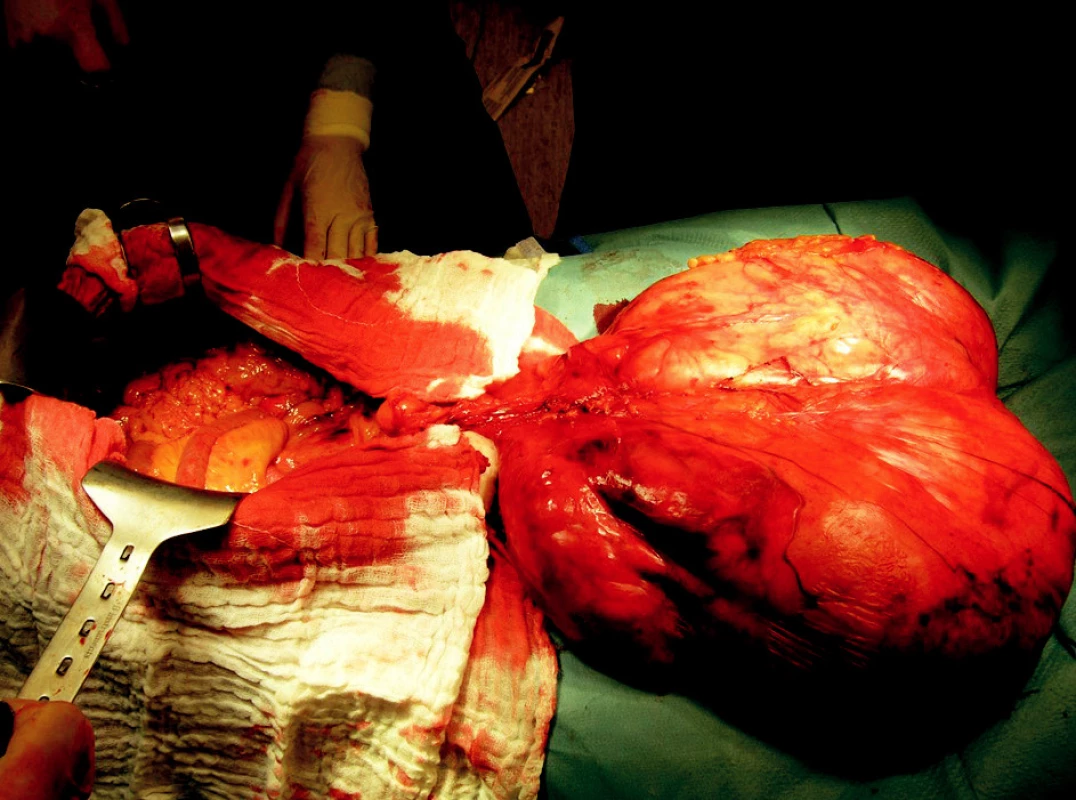 Peroperační nález u pacientky č. 2
Fig. 3. Peroperative finding in the patient No. 2