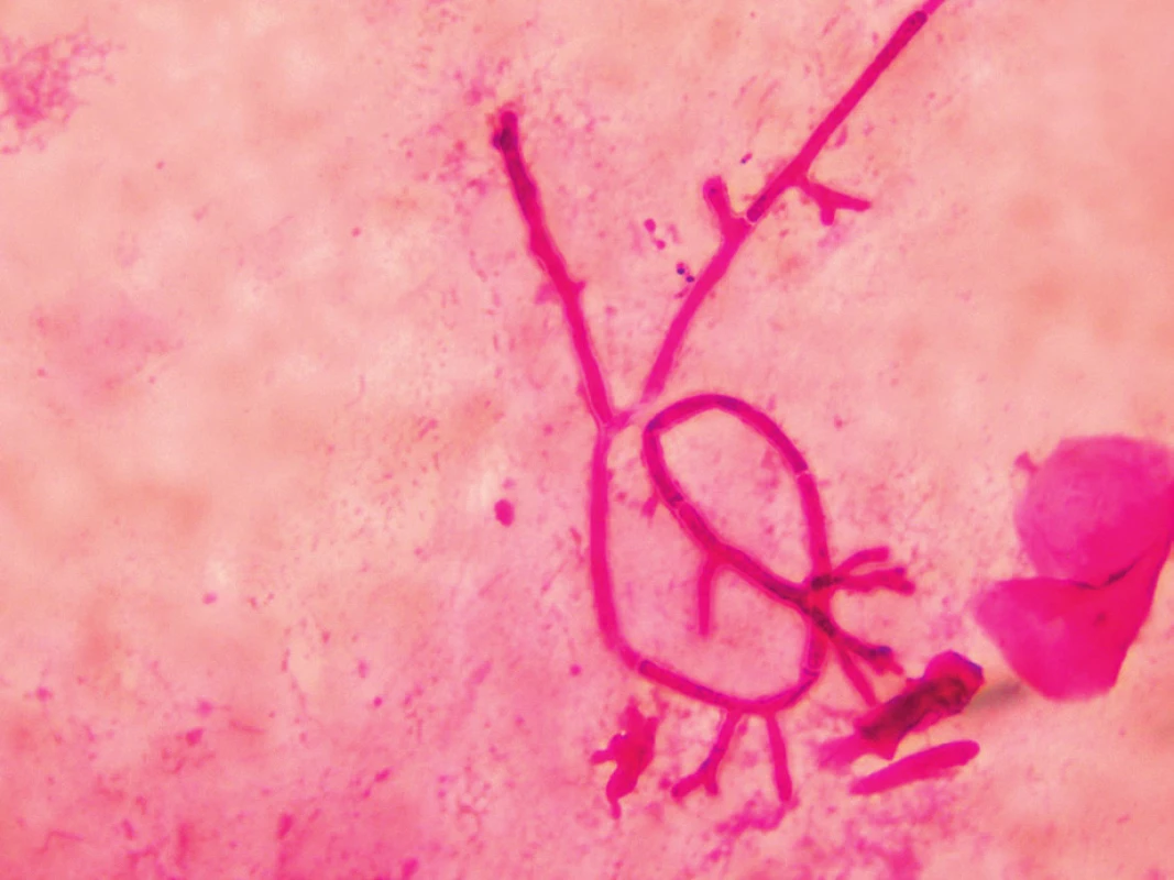 Aspergilová vlákna v bronchoalveolární tekutině, barvení podle Grama (foto autorka)
Figure 2. Aspergillus filaments in Gram stained bronchoalveolar lavage fluid (photo by the author)