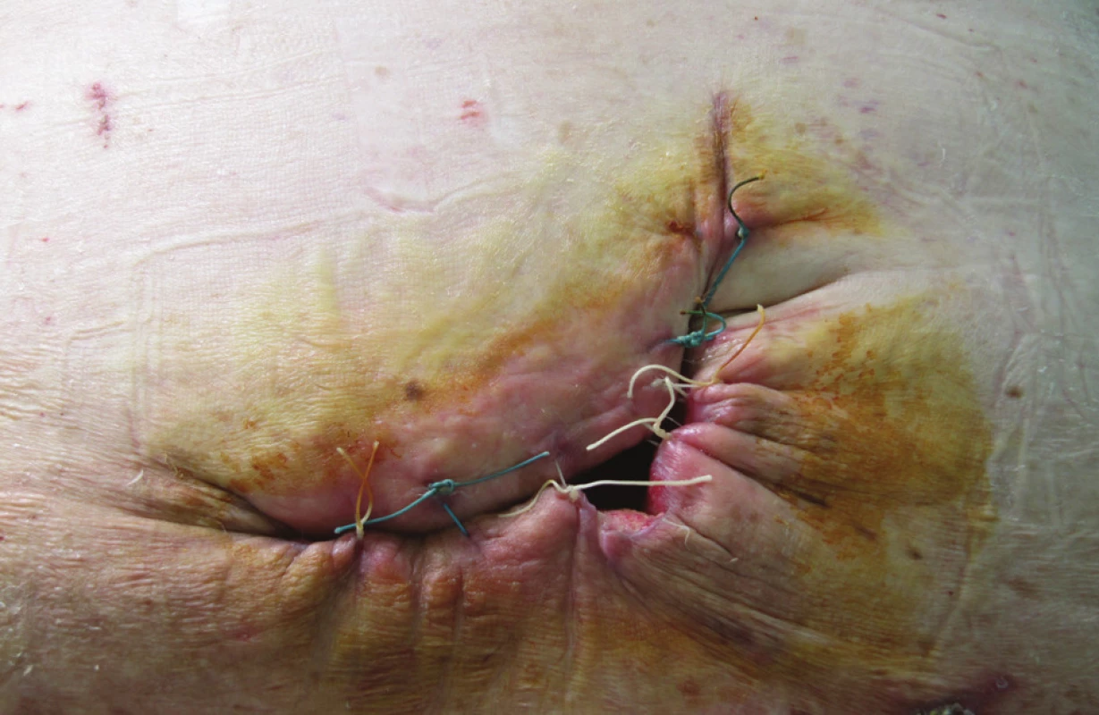 Měsíc po operaci
Fig. 7. One month after the surgery