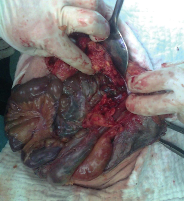 Operační foto
Fig. 5: Surgical picture