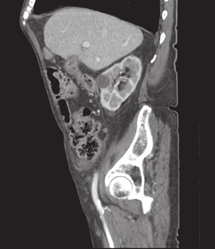 CT obraz – cholecystokolická píštěl
Fig. 3: Cholecystocolonic fistula (computed tomography finding)