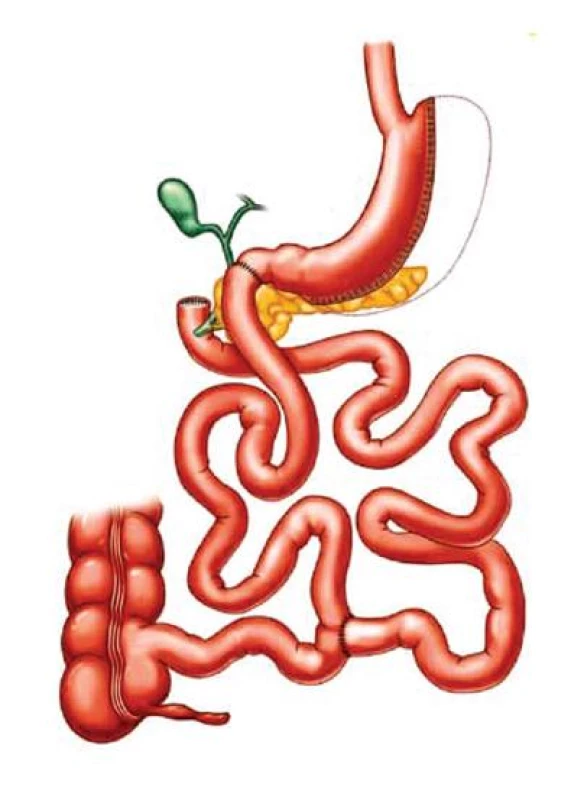 Biliopankreatická direrze s obejitím duodena“ (BPD-DS /duodenal switch/)