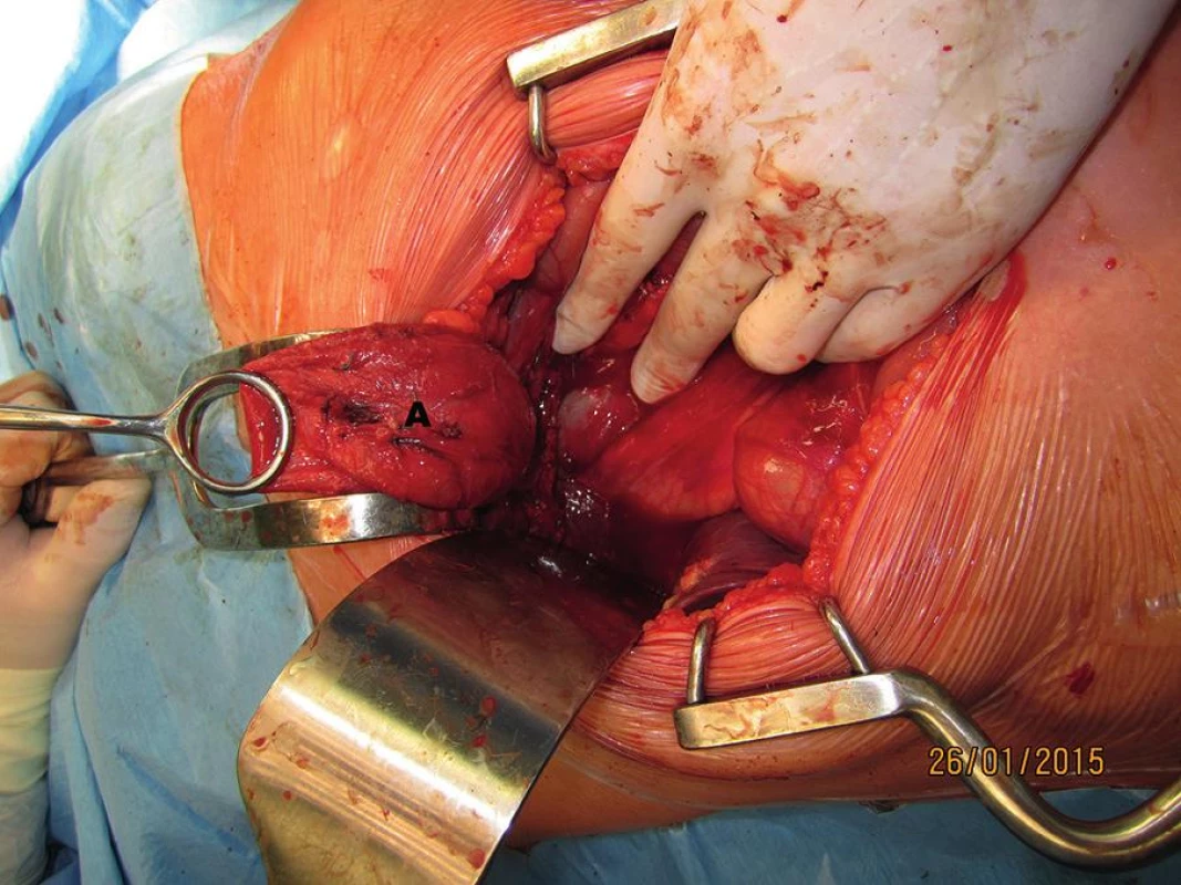 Laparotomie, transrektální řez v pravém podžebří (A – spodina cysty ductus choledochus po přerušení distálního choledochu)
Fig. 5: Laparotomy, transrectal incision in the right upper quadrant (A – base of the choledochal cyst after transection of the distal bile duct)