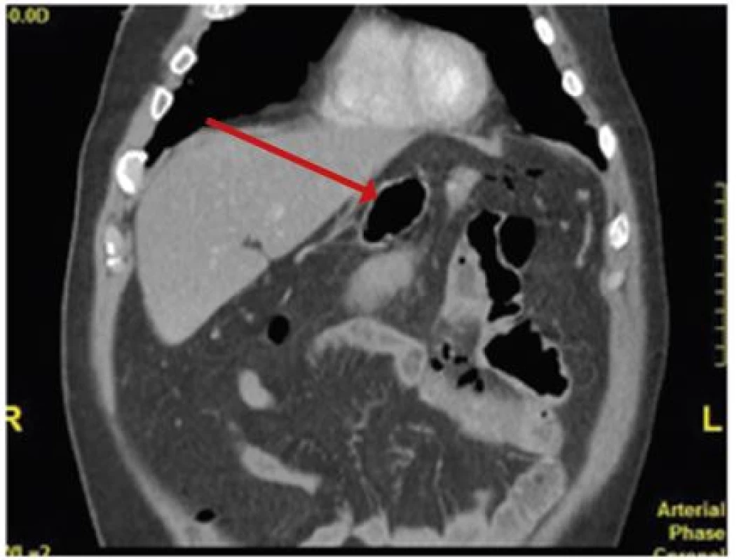 CT nález pneumoperitonea-šípka, zhrubnutá stena jejuna- vlastný materiál
Fig. 3: CT finding of pneumoperitoneum – arrow; thickened wall of the jejunum – our own material