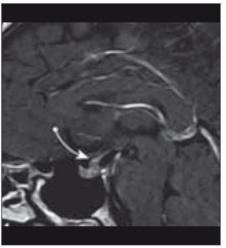 Infiltrace stopky hypofýzy (MRI vyšetření).