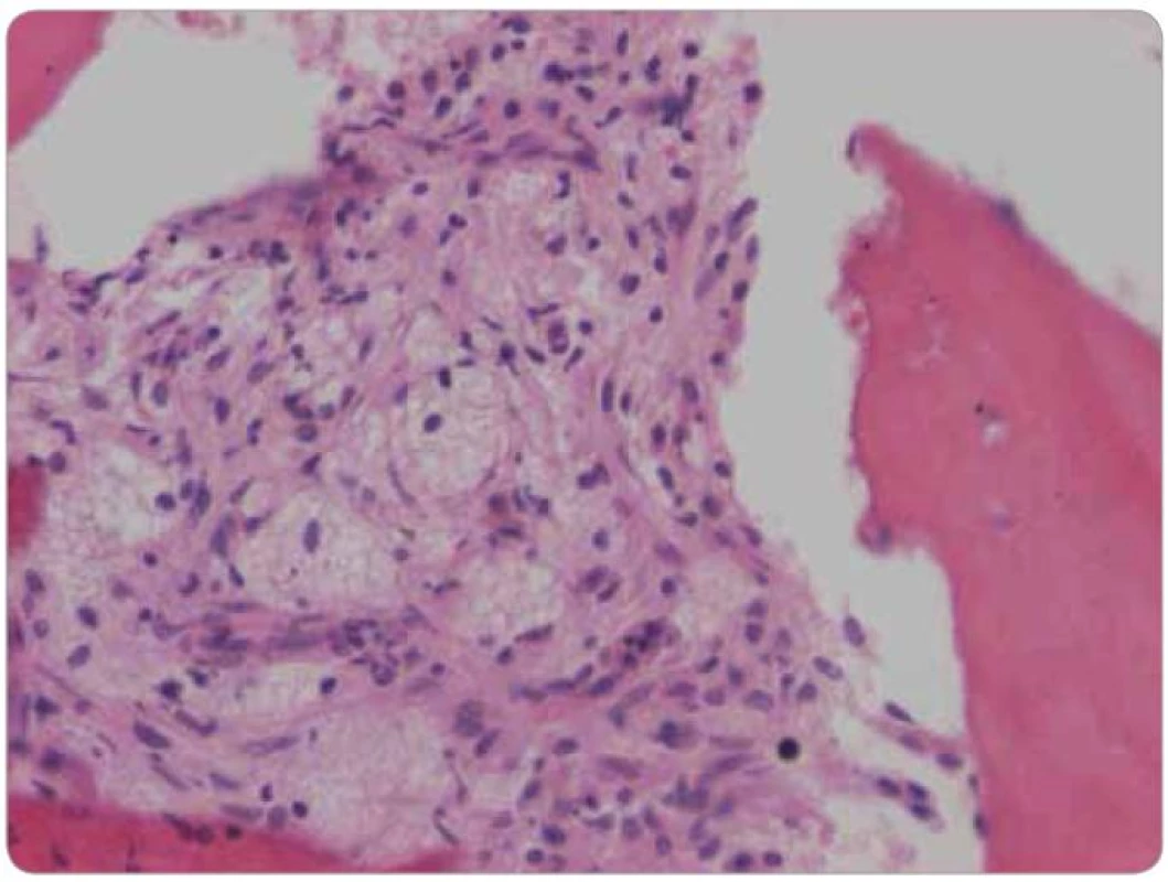 Histologické hodnocení válečku kostní dřeně. Barvení hematoxylin – eozin, zvětšení 200x. Pěnité a vřetenité histiocyty nahrazují hemopoetické buňky kostní dřeně.