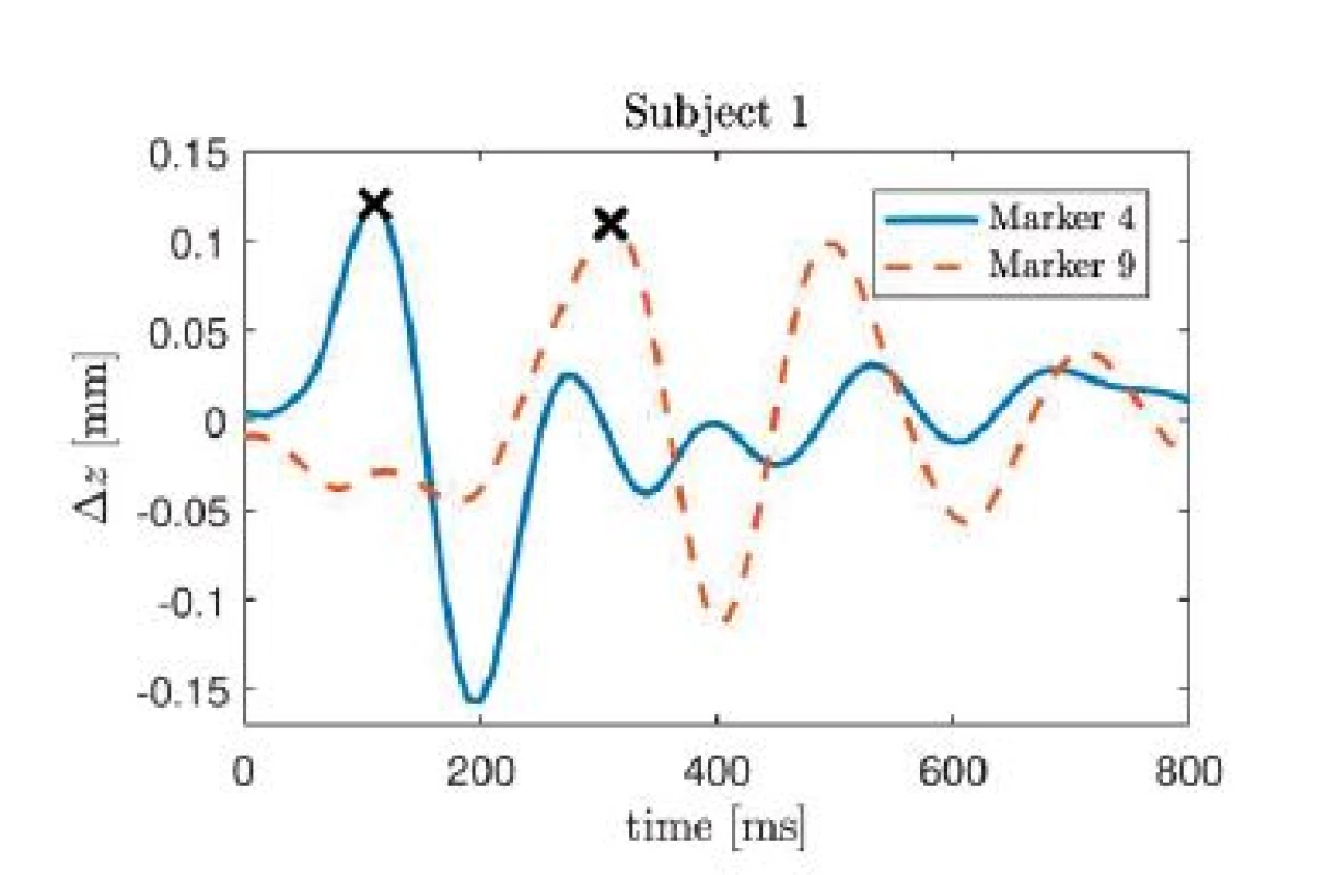 Impulse response of the z-component of cardiac induced thoracic movement for subject 1, markers 4 and 9. The each maximum value is marked with an x.