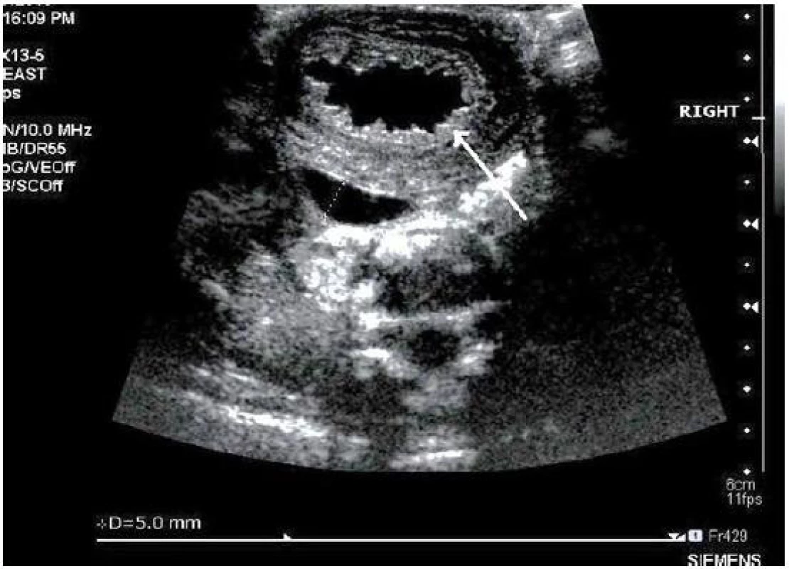 Ultrasonografie, pacient č. 13; šipka ukazuje na zesílenou a trabekulizovanou stěnu močového měchýře, jeho obsah je čirý; juxtavezikálně zobrazený ureter má šířku 5 mm (tečkovaně).

Fig. 3. Ultrasound, patient No 13; note thick and trabeculated bladder wall with content of clear urine (arrow); diameter of juxtavesical ureter is 5 mm (dotted line).