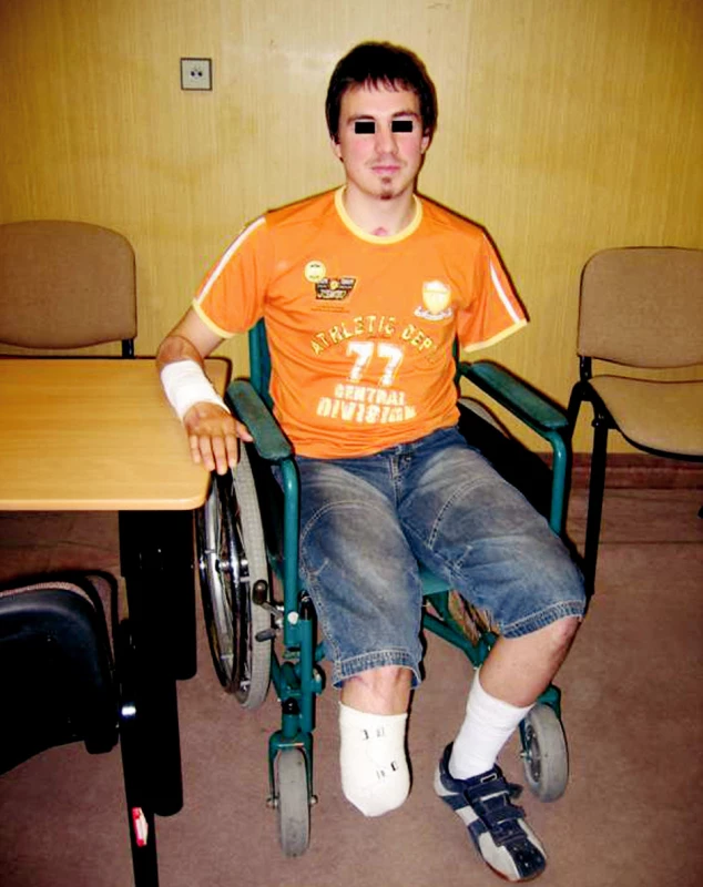 The patient 3 months after the high-voltage electric current injury