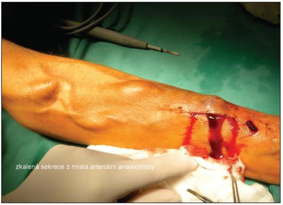 Zkalená sekrece z místa arteriální anastomózy
Fig. 1. Opaque secretion from the arterial anastomosis site
