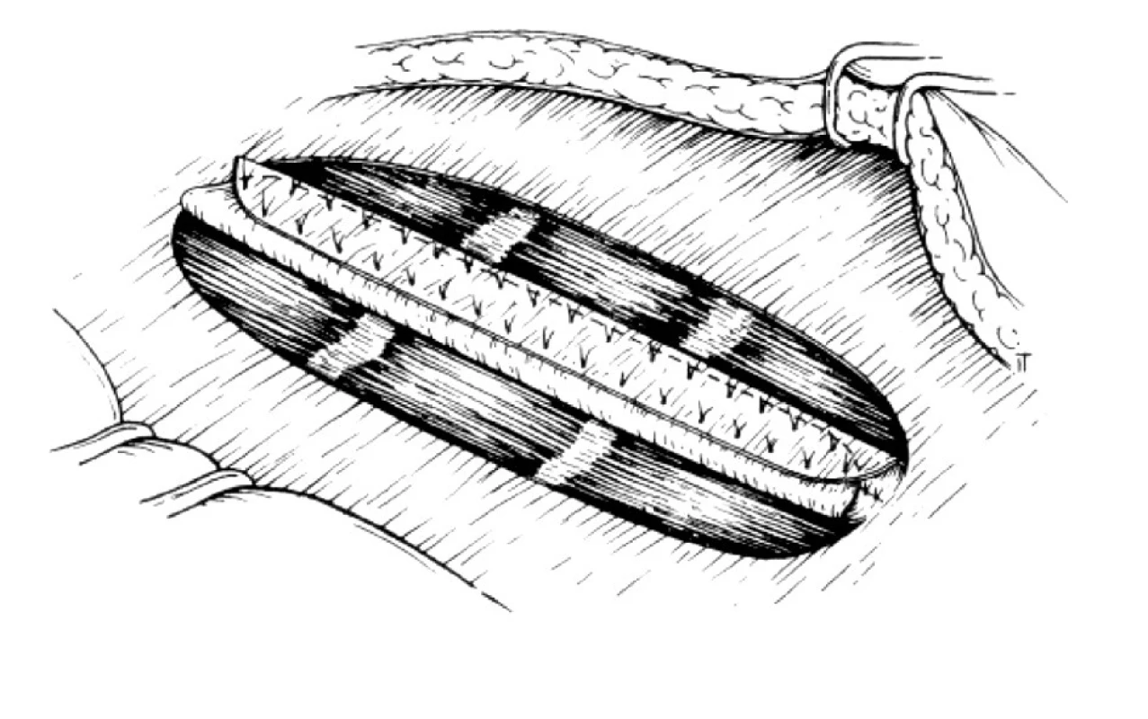 Stav po vykonaní relaxačných incízií a sutúre mediálnych okrajov predného listu fascie priamych brušných svalov
Fig. 2. The relaxing incisions and suturing of the medial edges of the mm.recti abdominis anterior sheath completed 