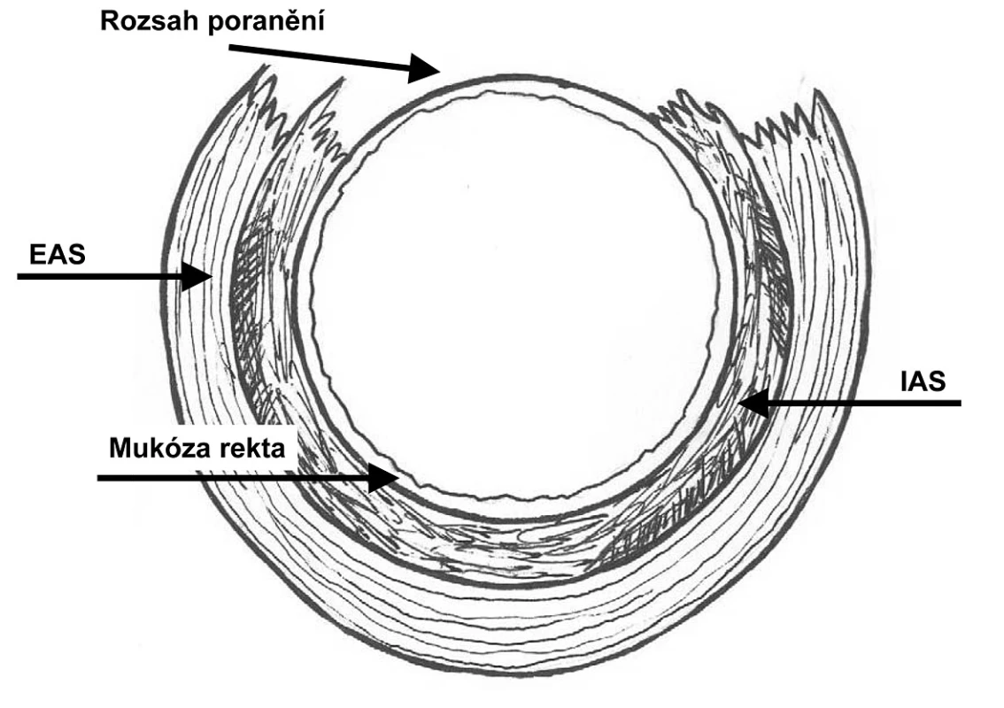 Ruptura perinea stupně 3c podle RCOG