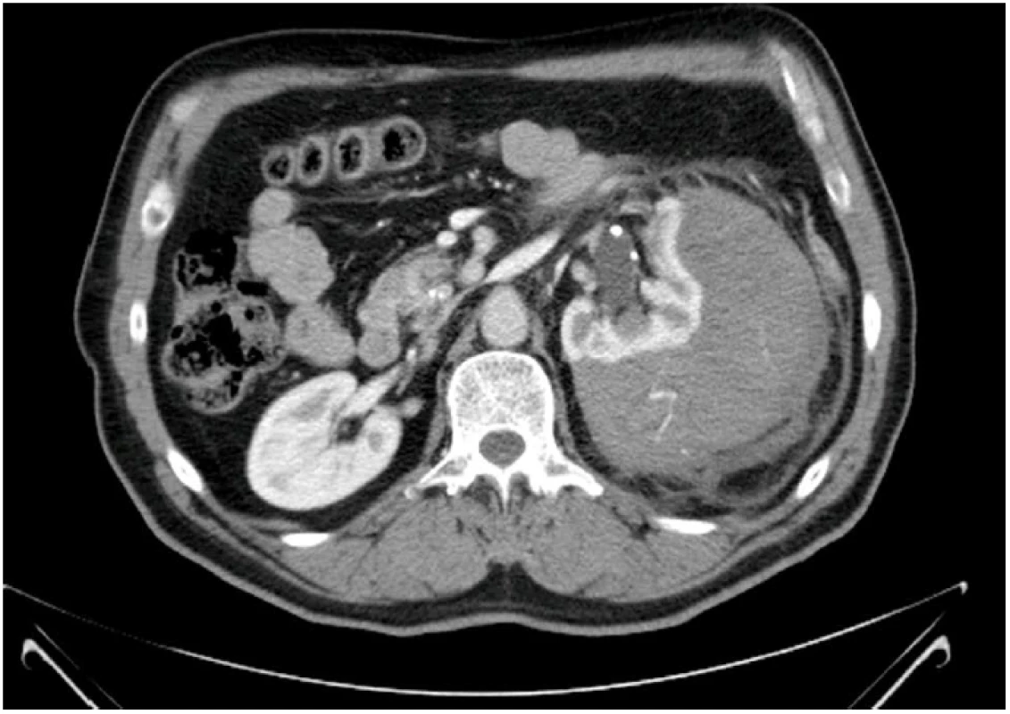 CT vyšetření s patrným hematomem a leakem kontrastní látky z ledviny
Fig. 1 CT scan with an apparent haematoma and leakage of contrast medium from the kidney