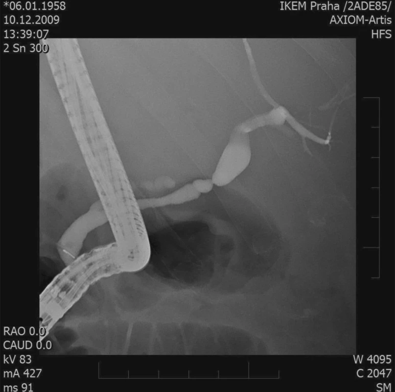 ERCP – stenóza žlučovodu
Fig. 2. ERCP – biliary duct stenosis