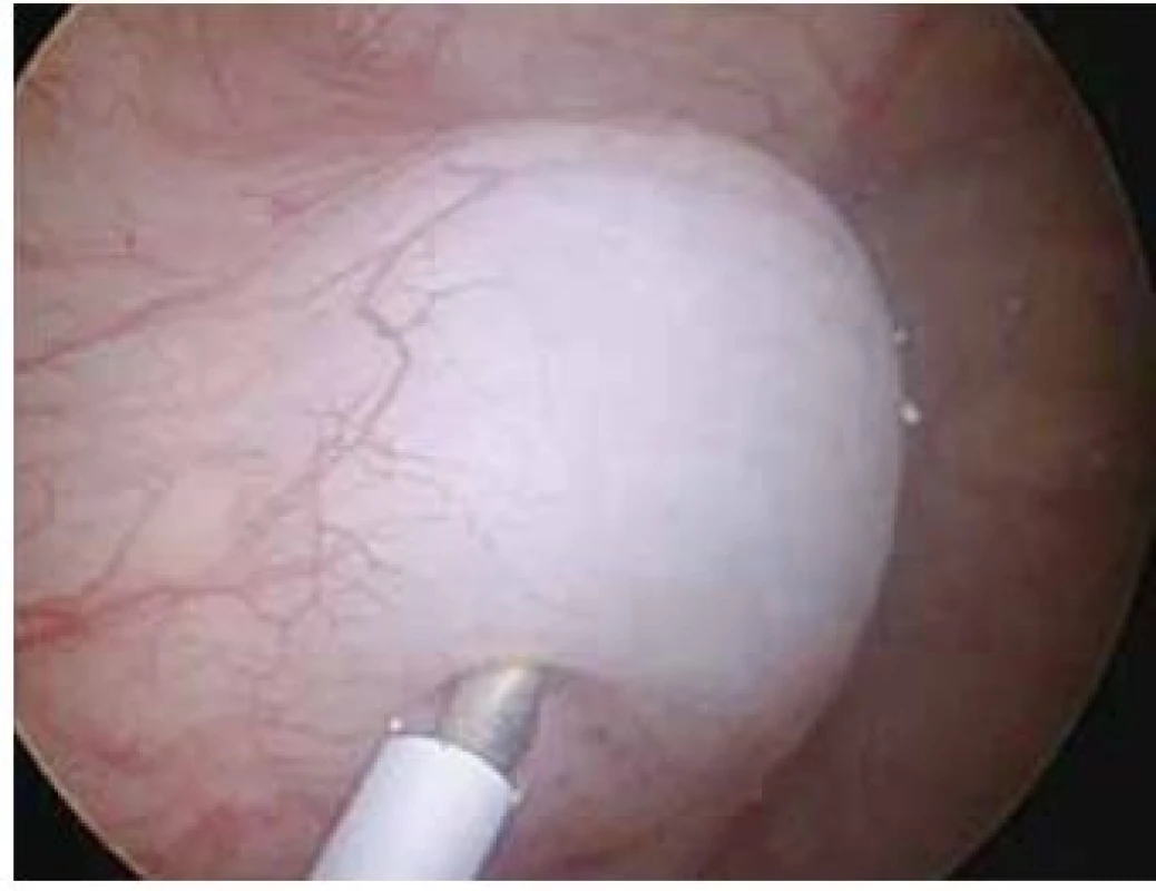 Subslizniční aplikace
Fig. 2. Submucosal application