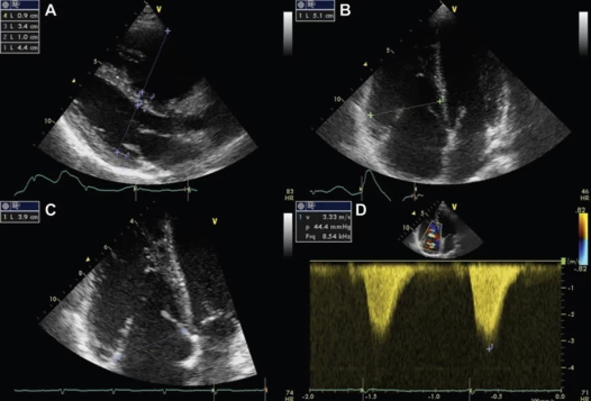 Transthoracic echocardiography after six months.