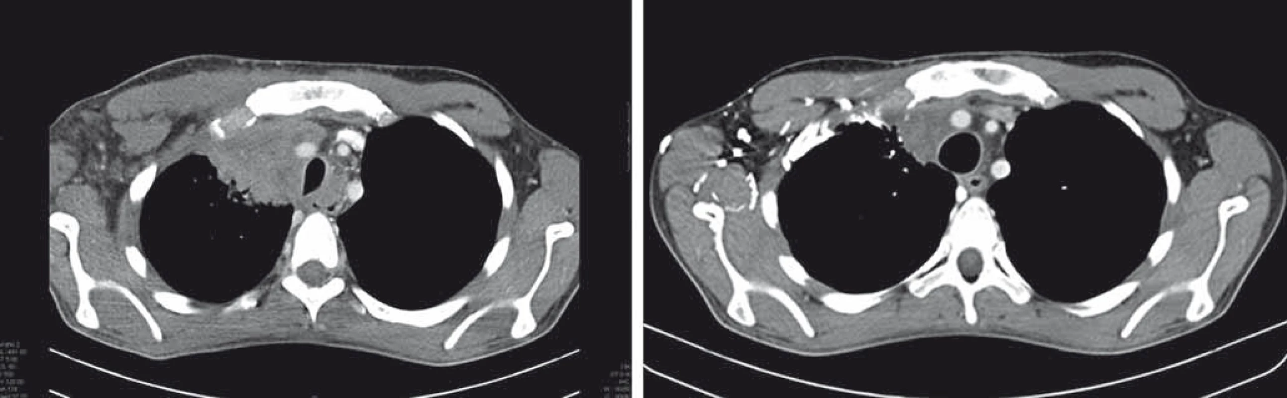 Efekt nivolumabu u nemocného s primárně rezistentním Hodgkinovým lymfomem, relapsem dva měsíce po autologní transplantaci, progredující na terapii brentuximabem vedotinem.