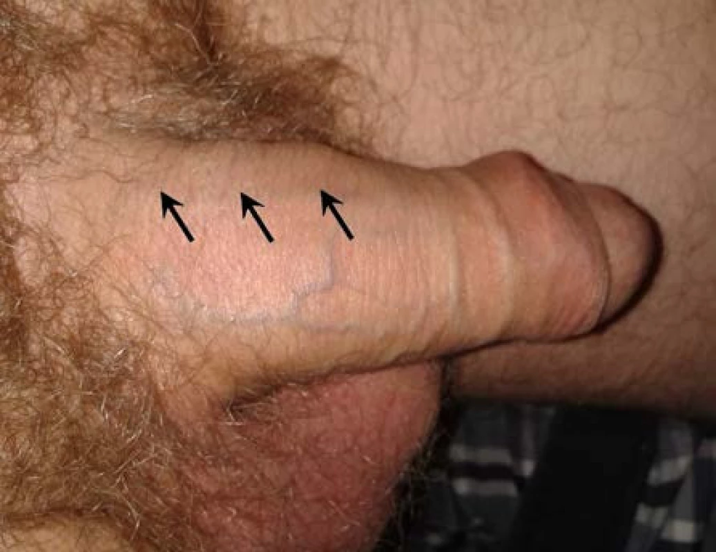 Penilní indurace
Fig. 1 Penile induration
