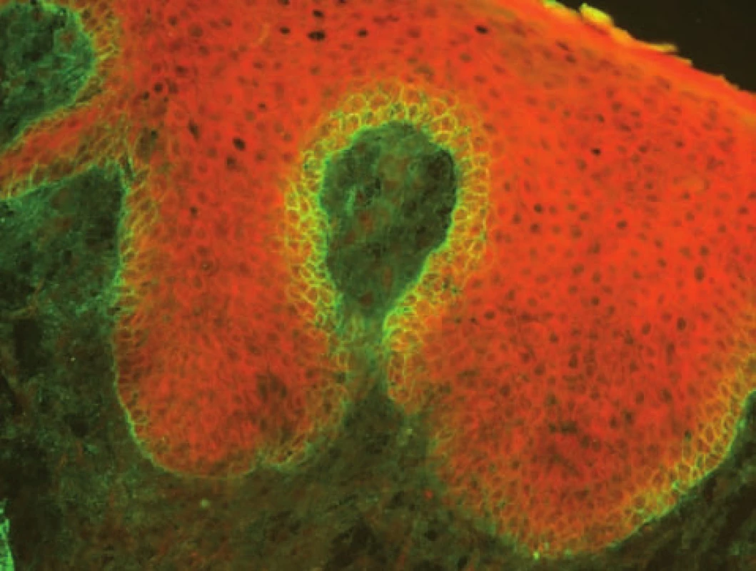 Pemphigus vegetans – pozitivní intercelulární substance v dolní části epidermis (přímá IF, C3)