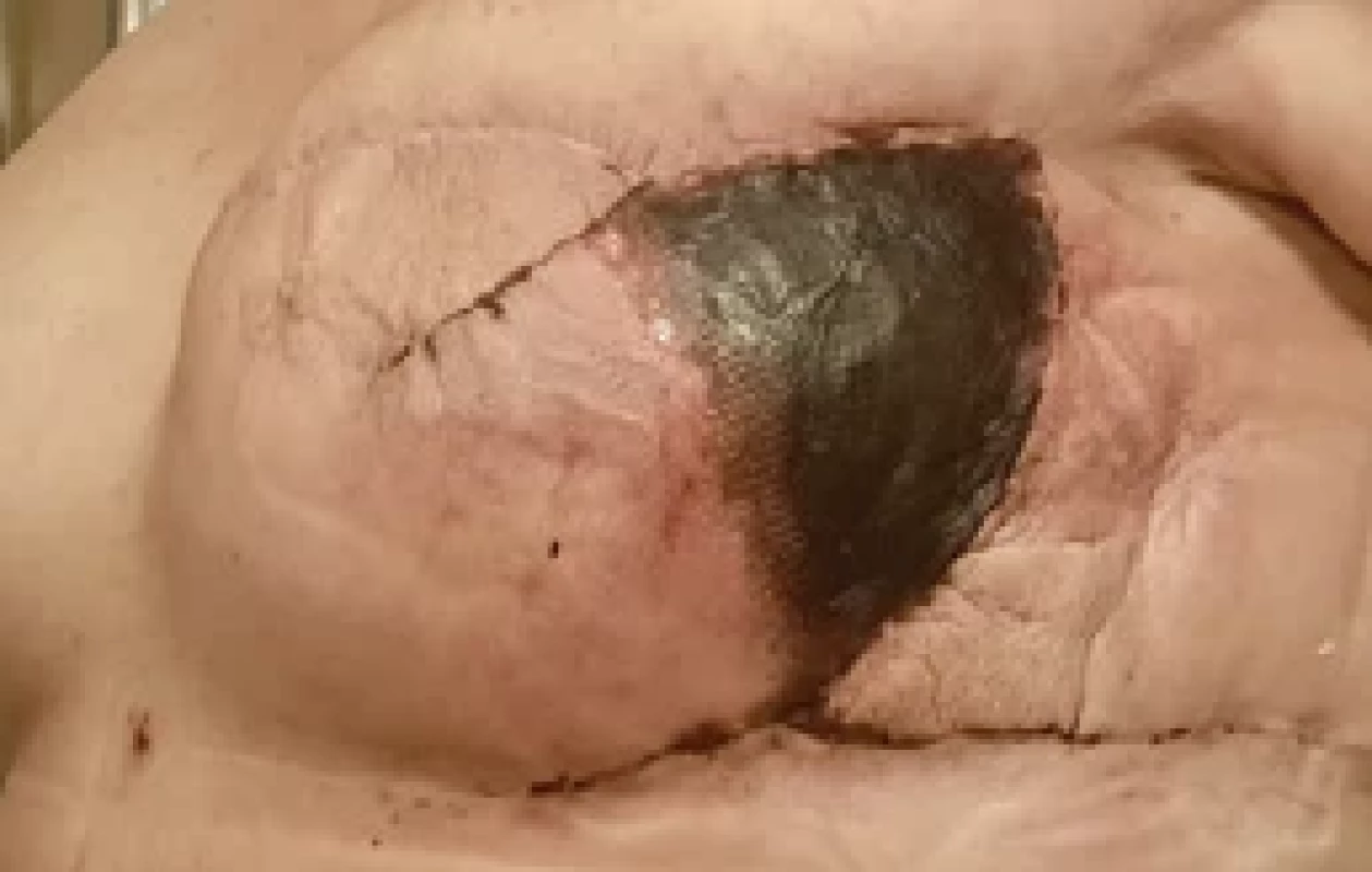 Flap necrosis.
