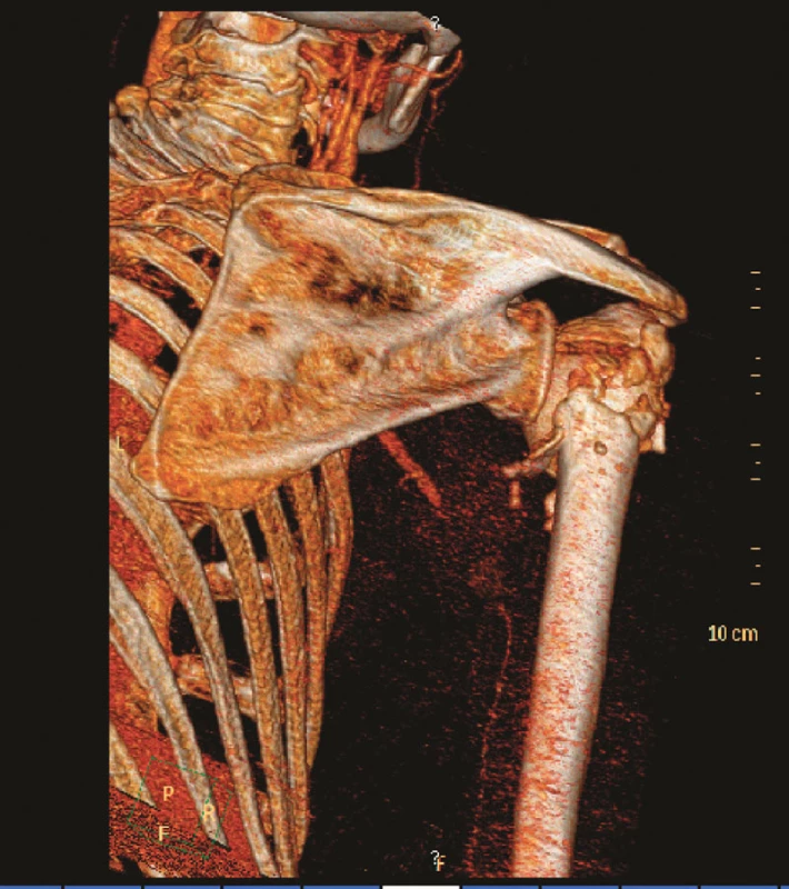 3D CT angiografie s patrnou okluzí 3. segmentu arteria axillaris
Fig. 2. 3D CT angiography depicting occlusion of the 3rd segment of the arteria axillaris