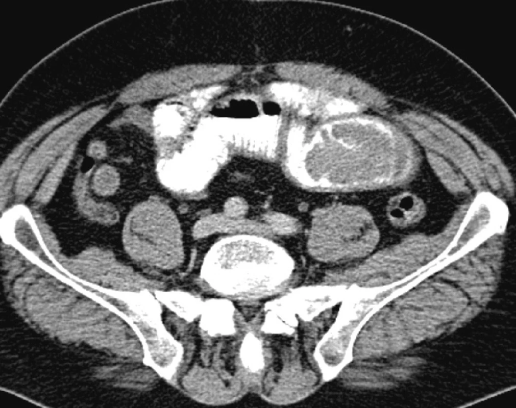 Nepravidelná hlava invaginátu – vedoucí bod
Fig. 3. Irregular head of the invaginated intestine – the key point