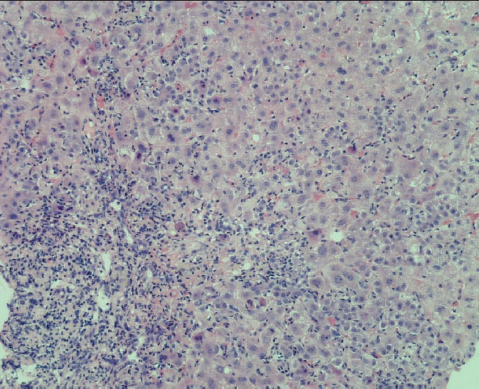 Intenzivní smíšená celulizace portálních polí s průnikem buněk zánětlivé celulizace hluboko do parenchymu 
Četné apoptotické hepatocyty (barvení HE).