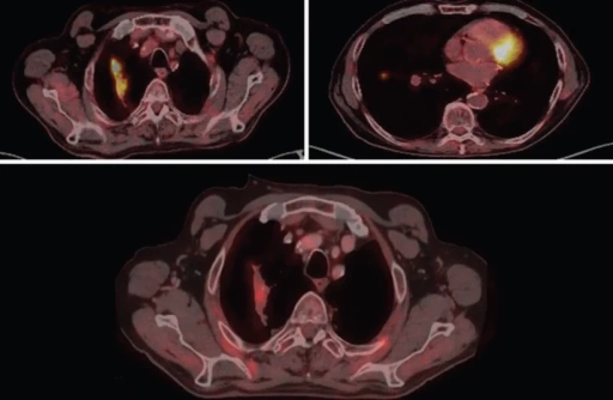 PET/CT při stanovení diagnózy a parciální regrese při léčbě cemiplimabem.