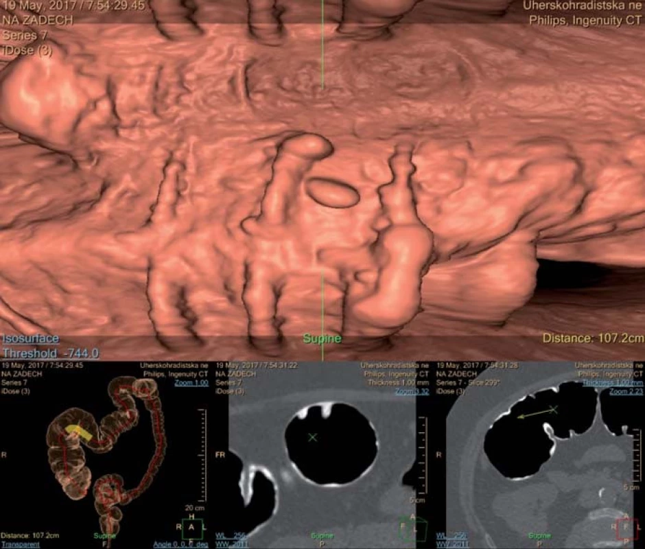 Faecal tagging baryem – baryem označené zbytky stolice v hepatální flexuře.
Fig. 	3. Faecal tagging with barium – barium tagged stool in the hepatic flexure.