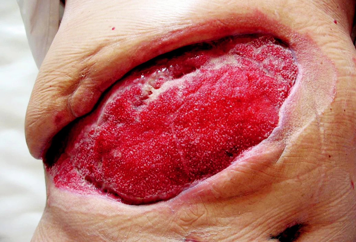 Po 14 dnech aplikace podtlaku
Obr. 3. After 14 days of the vacuum therapy application