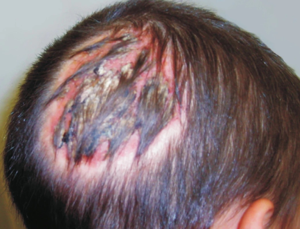 Tinea capitis vyvolaná <i>A. benhamiae</i> (kerion Celsi)