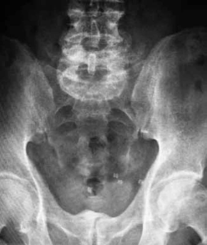 Nativní snímek břicha
Fig. 1. Abdominal X-ray