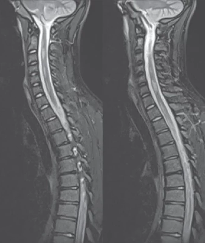 MR míchy s nálezem demyelinizačních lézí v celém míšním rozsahu – prosinec 2022 (sekvence T2 STIR).</br>Fig. 6. MRI of the spinal cord showing demyelinating lesions in the whole spinal cord – December 2022 (T2 STIR sequence).